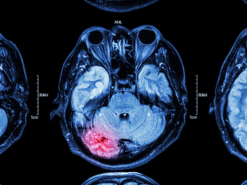 brain_mri brain mri