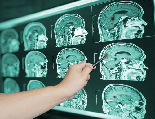 traumatic brain injury lawyer, Charlotte traumatic brain injury, traumatic brain injury, LawyerPower traumatic brain injury lawyer in Charlotte.
